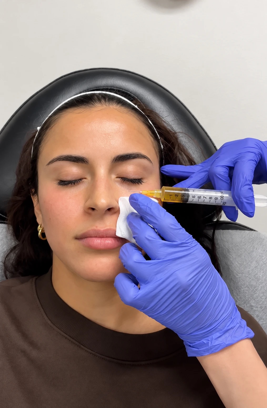 Golden platelet-rich fibrin drawn from the patient's own blood, ready to inject
