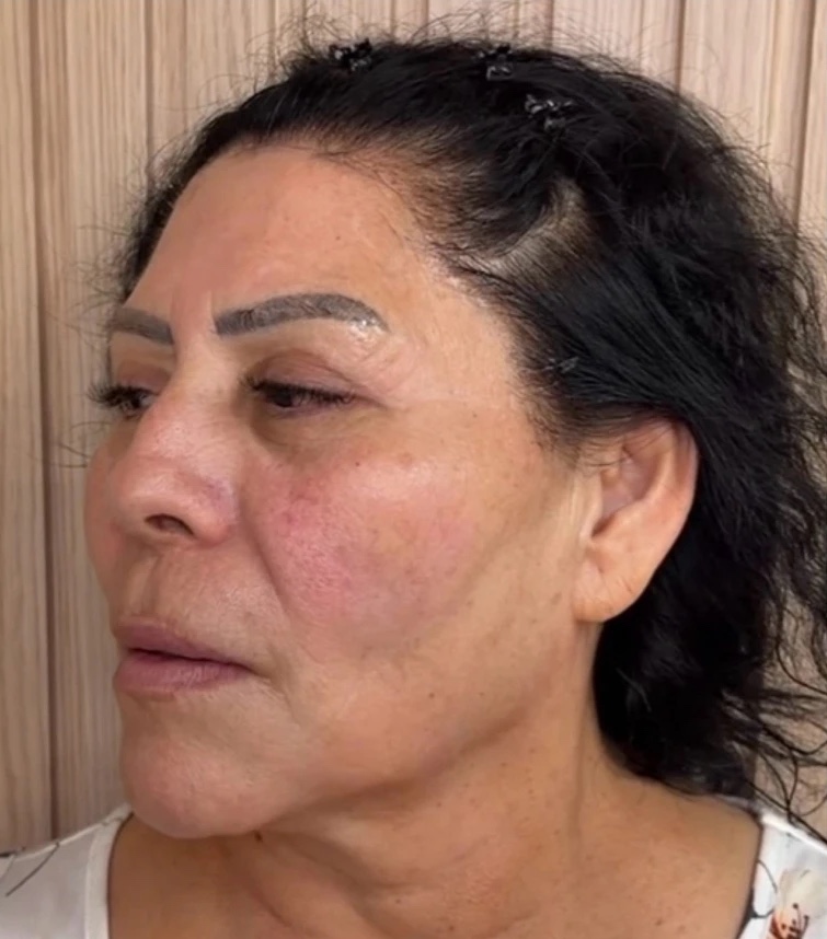 After XERF skin tightening at Beauty Bungalow: cheeks lifted, jawline smoothed