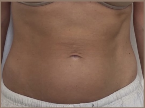 Abdomen after XERF skin tightening