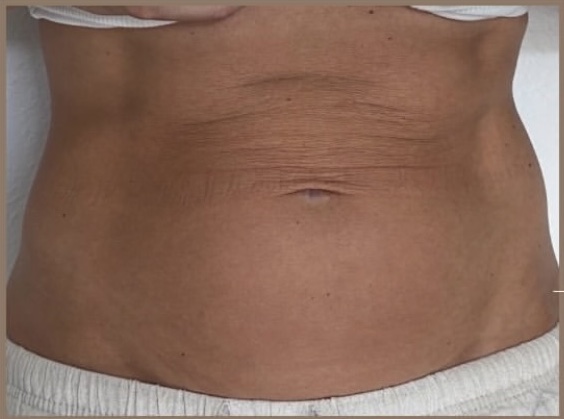 Abdomen before XERF skin tightening