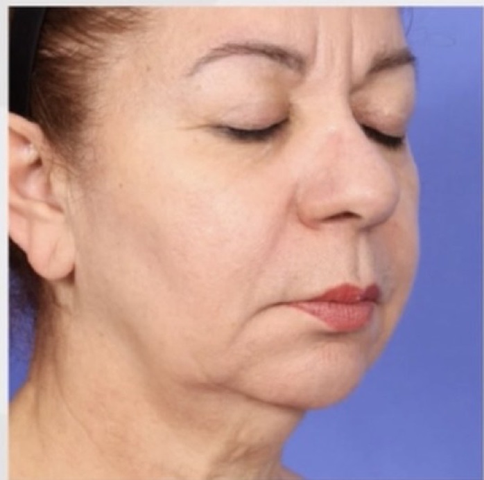 Mid-Face and Jowls after XERF skin tightening