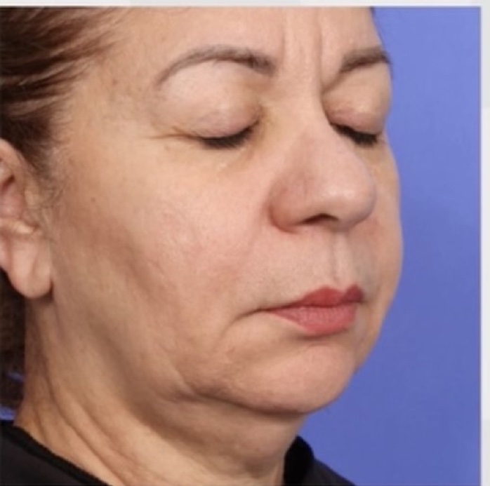 Mid-Face and Jowls before XERF skin tightening