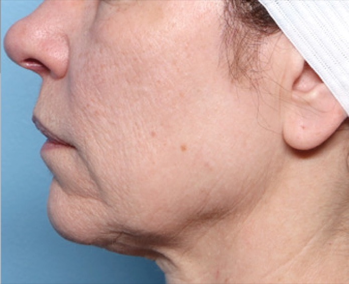 Lower Face and Neck after XERF skin tightening