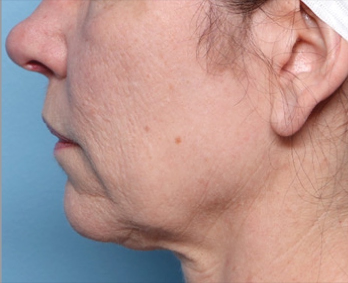 Lower Face and Neck before XERF skin tightening