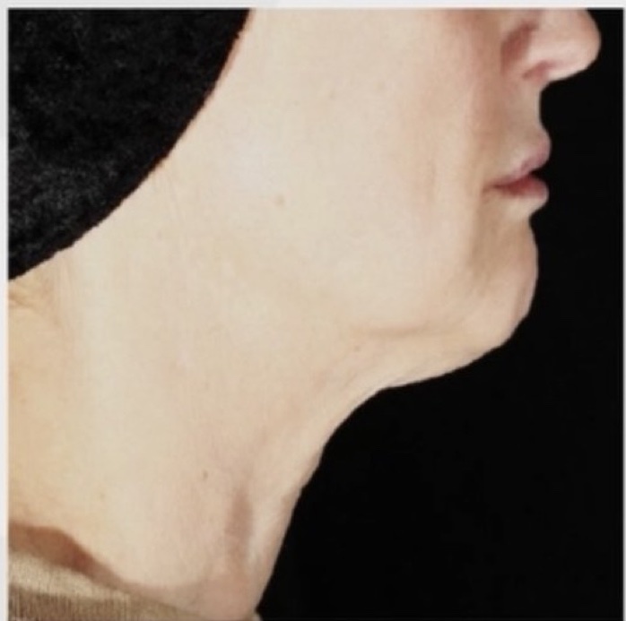 Neck and Jawline after XERF skin tightening