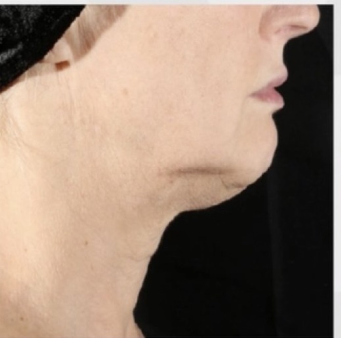Neck and Jawline before XERF skin tightening