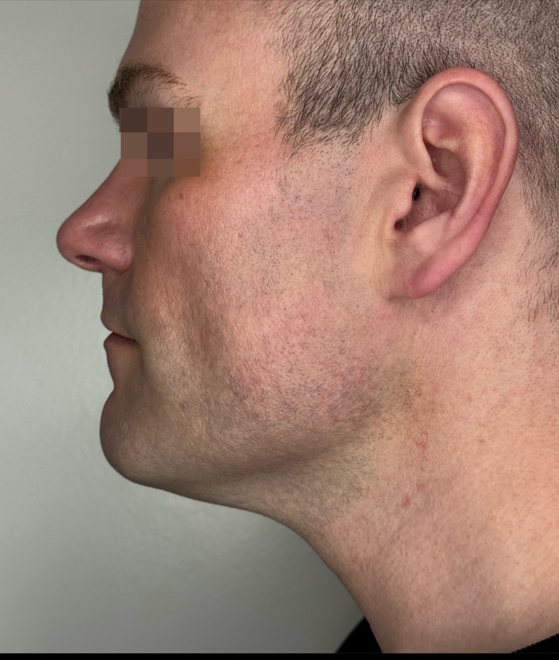 Jawline and Submental after XERF skin tightening