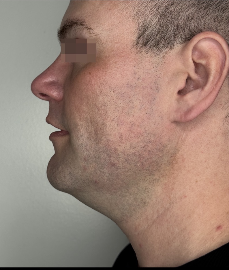 Jawline and Submental before XERF skin tightening