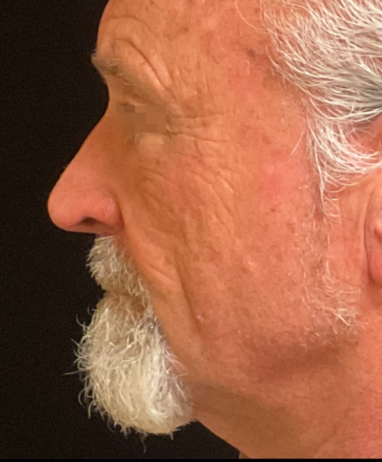 Cheek and Jaw Texture after XERF skin tightening