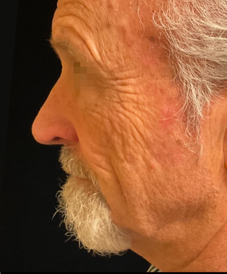 Cheek and Jaw Texture before XERF skin tightening